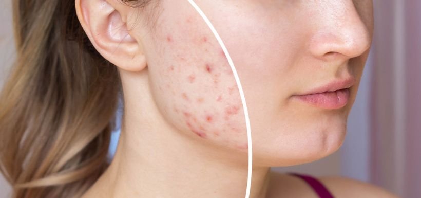 Traitement acné dermatologue Hay Hassani Casablanca